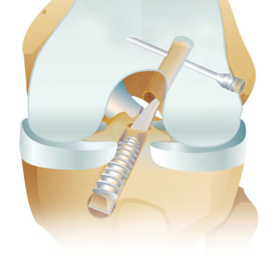 BioComposite™ TransFix®