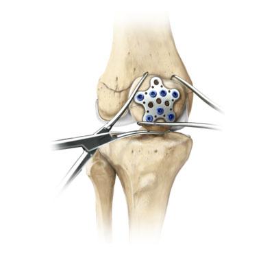 Patella SuturePlate™